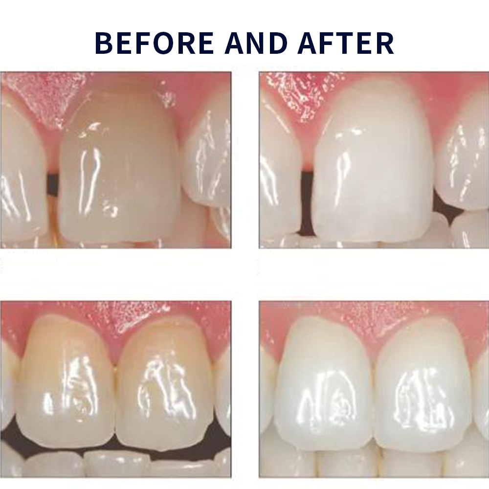 Opalescence Whitening 20% PF 2 - Teeth Whitening Near Me 评论和价格