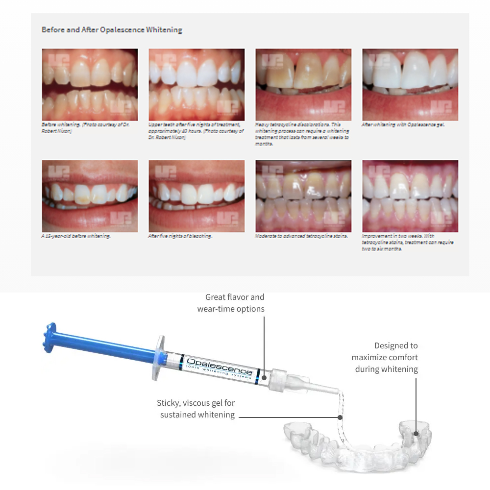 Opalescence Whitening 20% PF 2 - Teeth Whitening Near Me 评论和价格