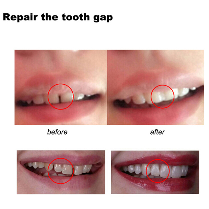 Temporary Tooth Repair Kit Tee - Teeth Whitening Kit 评论和价格